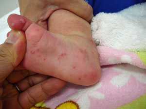 手足口病の足の発疹画像