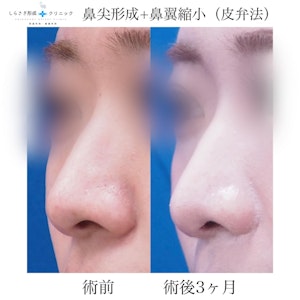 鼻翼縮小1
