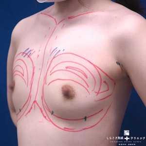 豊胸（脂肪注入）の症例写真1