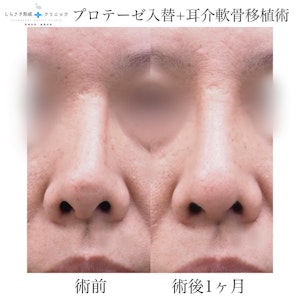 鼻プロテーゼ入替の症例写真2