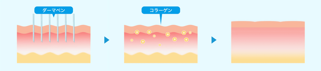 ダーマペンの効用