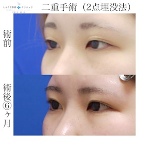 二重埋没法の症例写真1