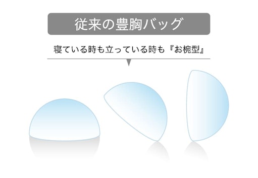 従来の豊胸バッグ
