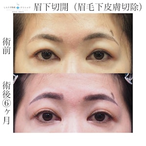 眉下切開の症例写真2
