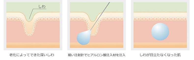 ヒアルロン酸注入イメージ