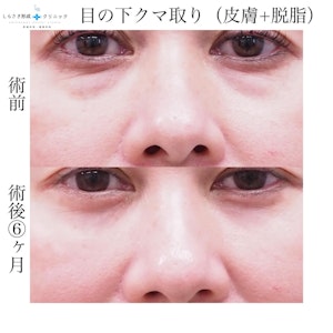 目の下のクマ取りの症例写真2
