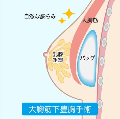 大胸筋下豊胸手術