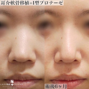 鼻プロテーゼの症例写真1