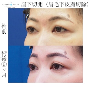 眉下切開の症例写真1