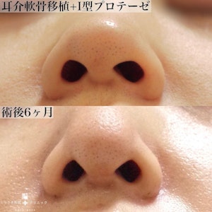 鼻プロテーゼの症例写真2