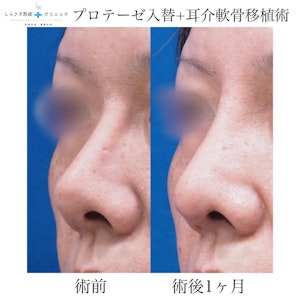 鼻プロテーゼ入替の症例写真1