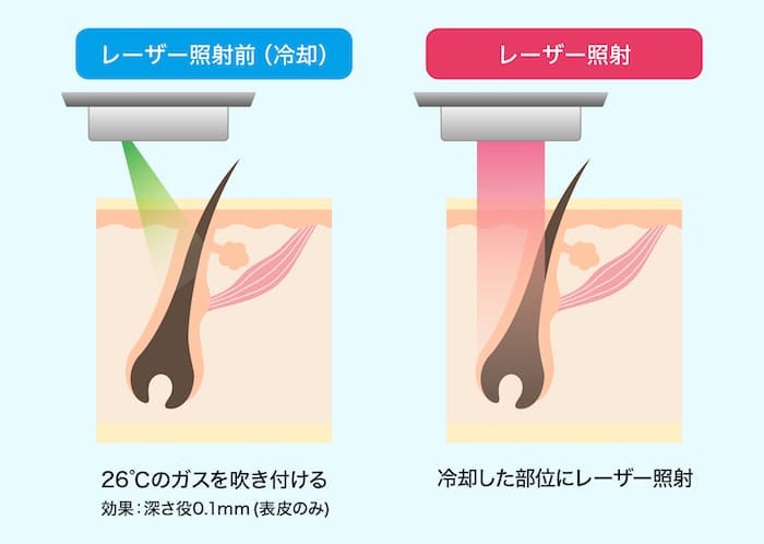 レーザー照射の仕組み