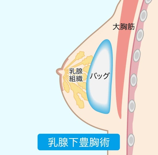 乳腺下豊胸術