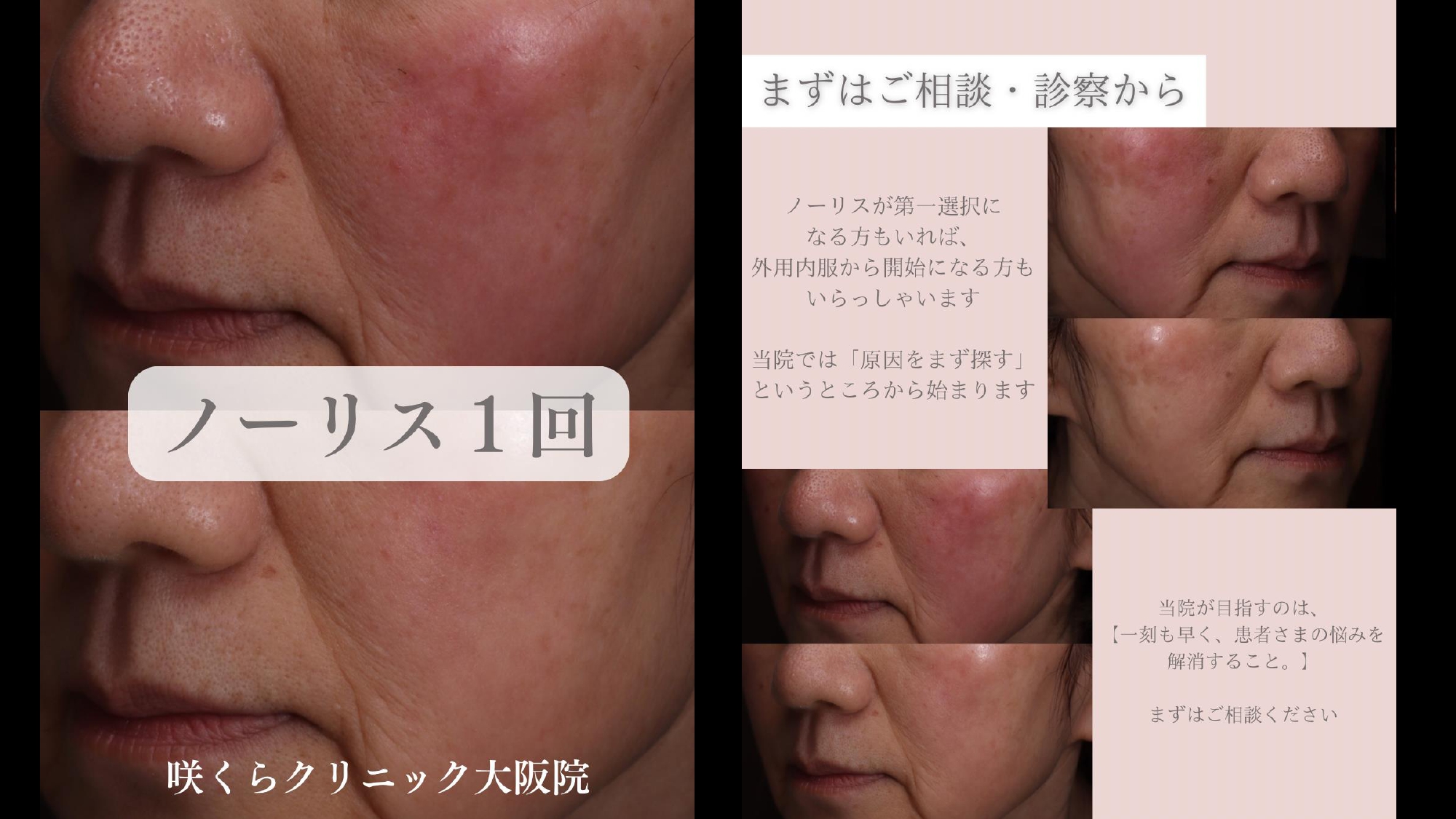 ノーリスによる治療前と治療後