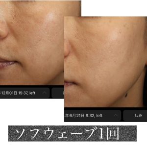 直後からギュッと締まる効果もさながら、長期効果が望めるのもソフウェーブの素晴らしいところ