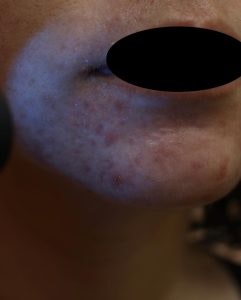 マラセチア毛包炎