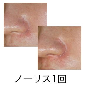 IPLノーリスによる小鼻の赤み（血管）治療例。IPLはどの機種でも血管にはそこそこ効くデバイスなのですが、特にノーリスは赤み治療（血管治療）に強い