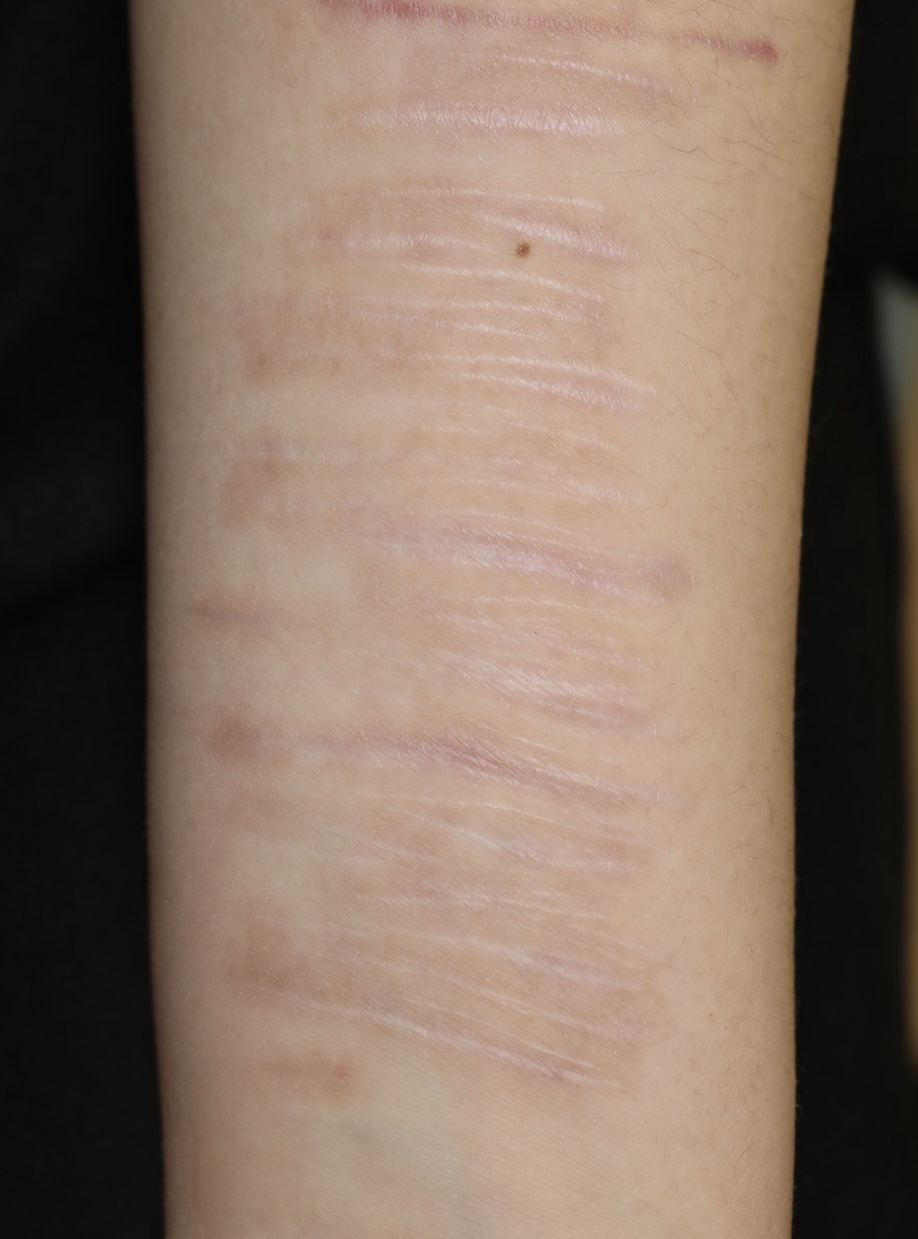 リストカットの跡を治したい。新しいマシン「ビーワン」による治療効果