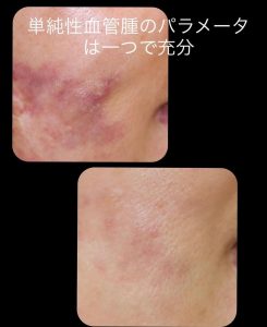 赤アザ＝単純性血管腫：治療は主にレーザー