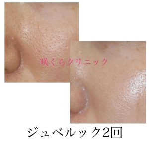 ジュベルックはコラーゲンブースターと称される薬剤
