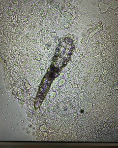 臨床家からコメントしますと、赤みがあってむず痒さを伴うような方からはニキビダニは高い確率で検出できますが、痒みもなく膿疱もなく、赤みもない方からはどんなにがんばってもうまく検出ができないのが実際です。