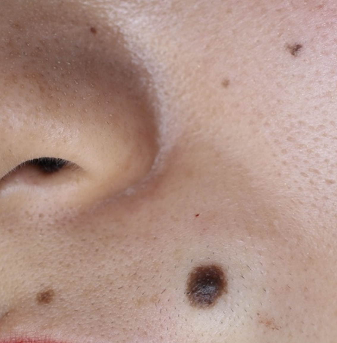 ほくろの綺麗な取り方講座。by 咲くらクリニック | 咲くらクリニック