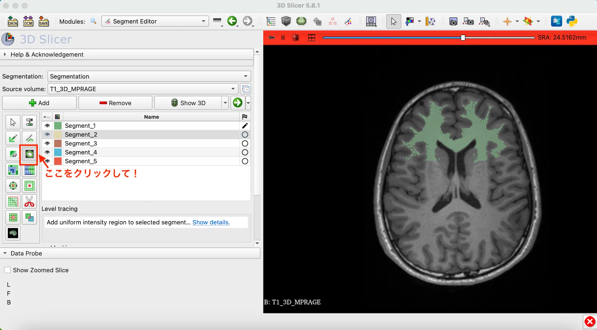 3D Slicer徹底解説！確認からセグメンテーションまで医療画像用の処理ツールを実際につかってみよう！ 本文画像24