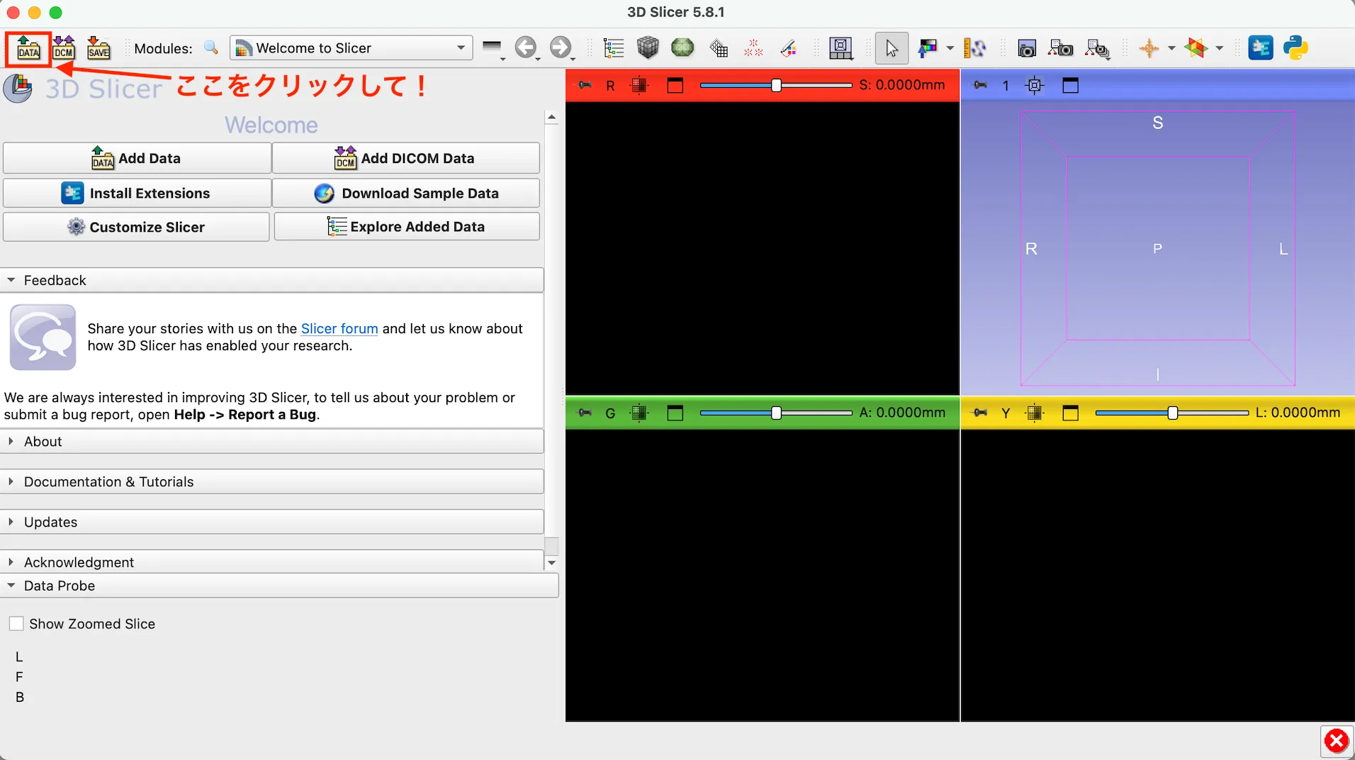 3D Slicer徹底解説！確認からセグメンテーションまで医療画像用の処理ツールを実際につかってみよう！ 本文画像7