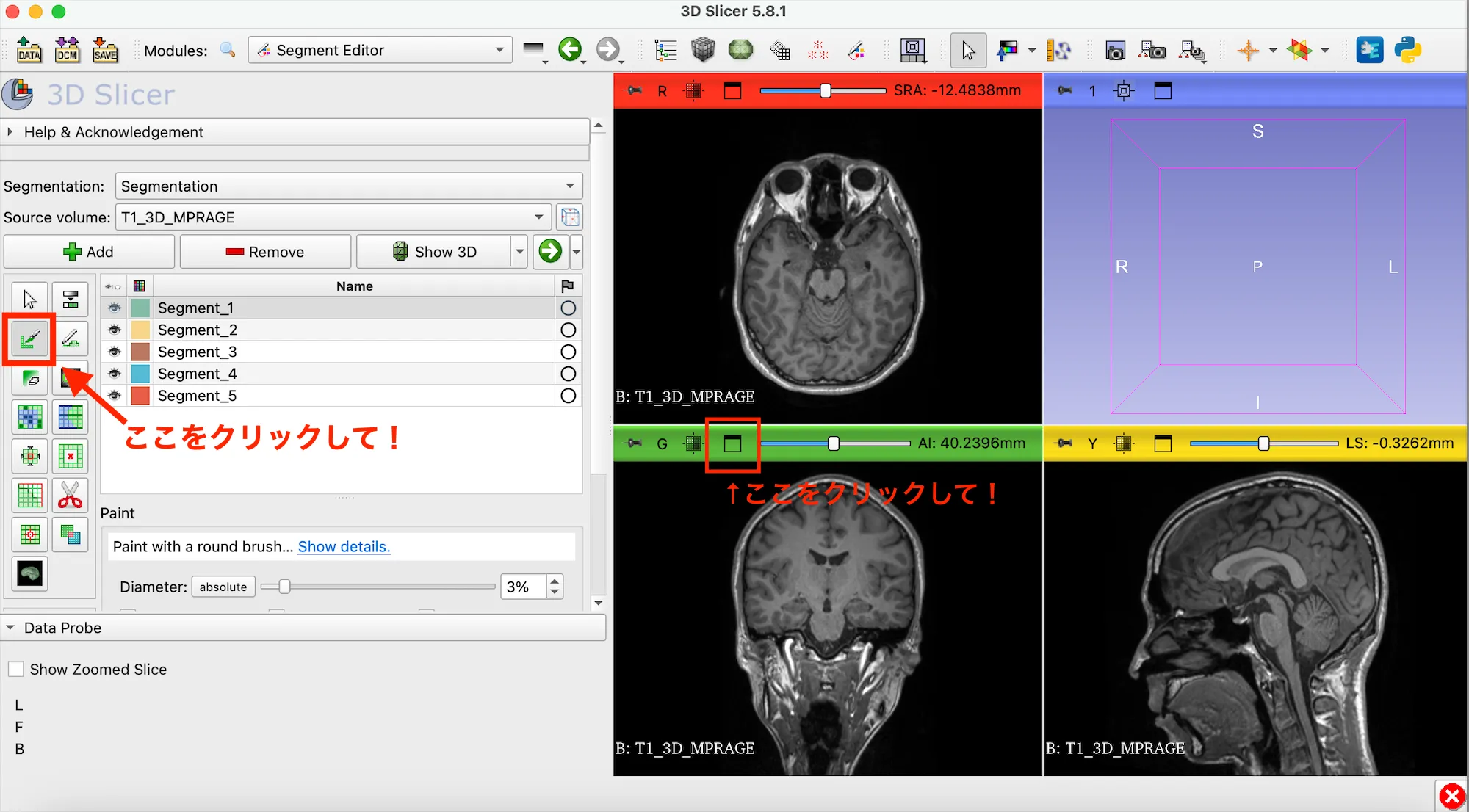 3D Slicer徹底解説！確認からセグメンテーションまで医療画像用の処理ツールを実際につかってみよう！ 本文画像18