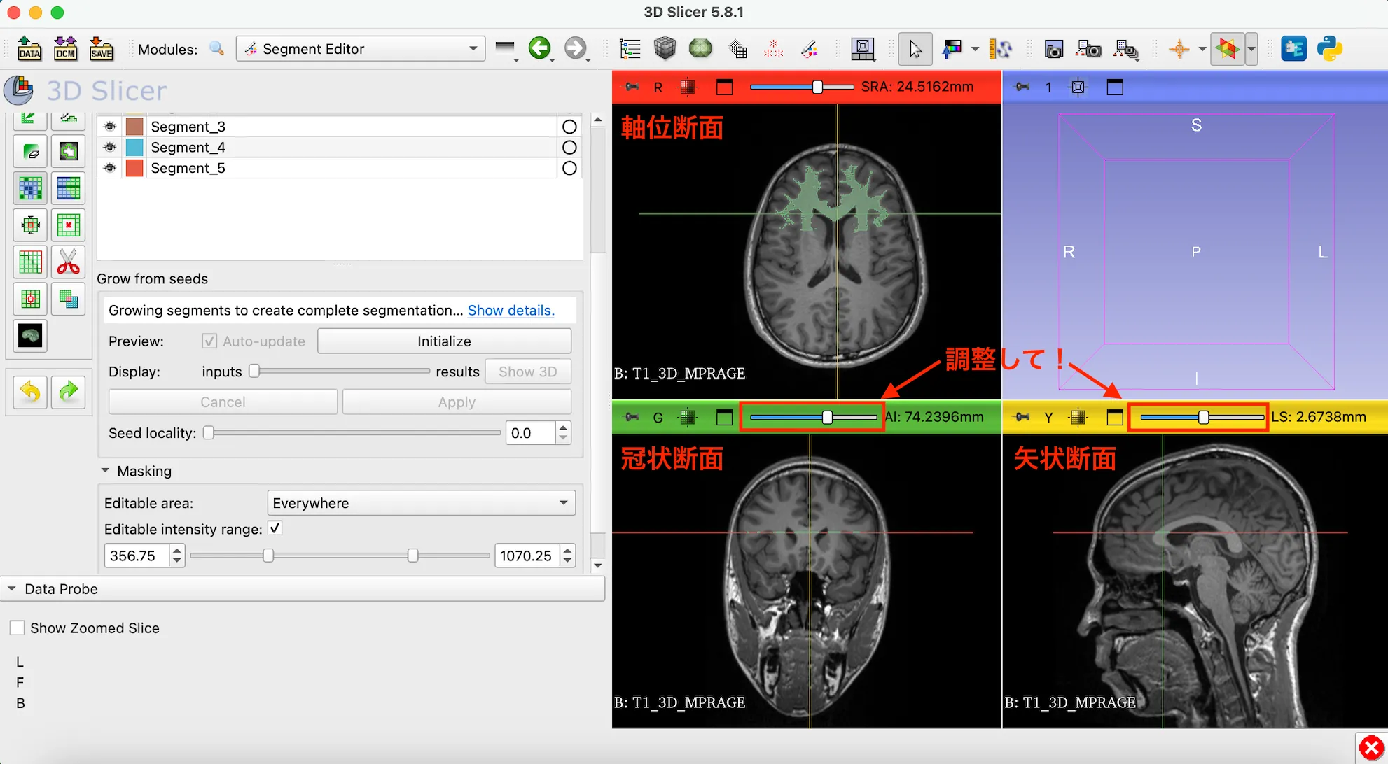 3D Slicer徹底解説！確認からセグメンテーションまで医療画像用の処理ツールを実際につかってみよう！ 本文画像27