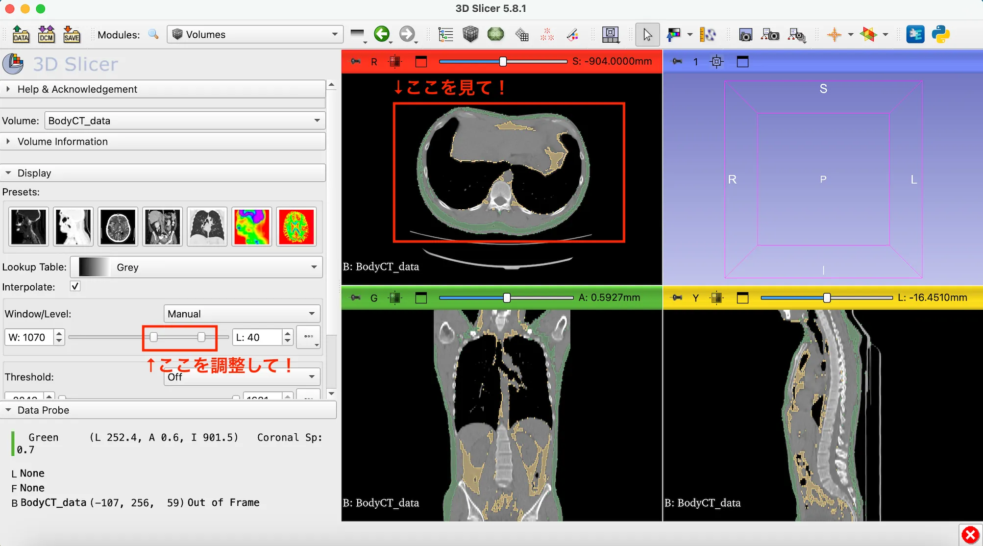 3D Slicer徹底解説！確認からセグメンテーションまで医療画像用の処理ツールを実際につかってみよう！ 本文画像37