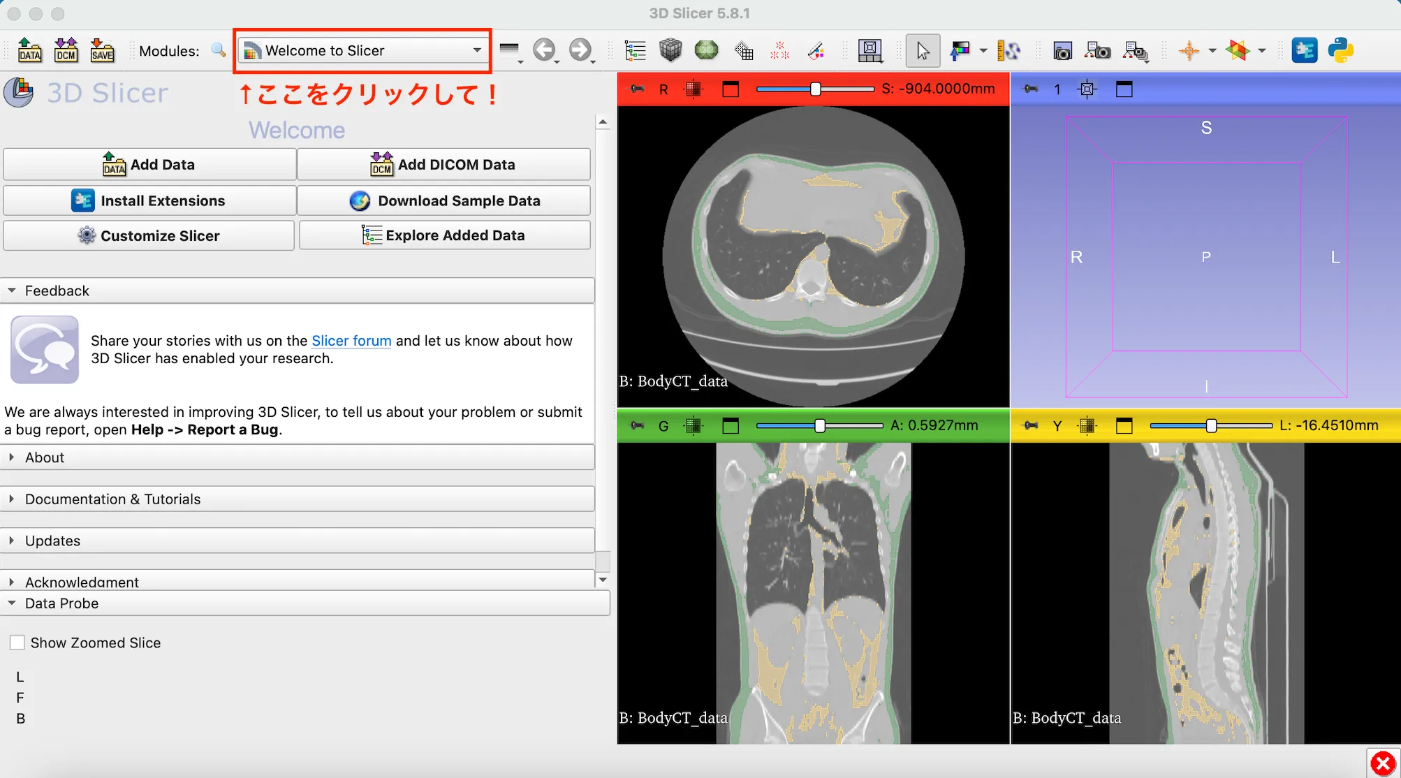 3D Slicer徹底解説！確認からセグメンテーションまで医療画像用の処理ツールを実際につかってみよう！ 本文画像34