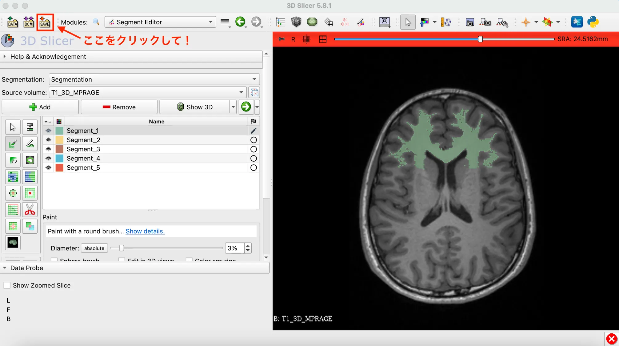 3D Slicer徹底解説！確認からセグメンテーションまで医療画像用の処理ツールを実際につかってみよう！ 本文画像28
