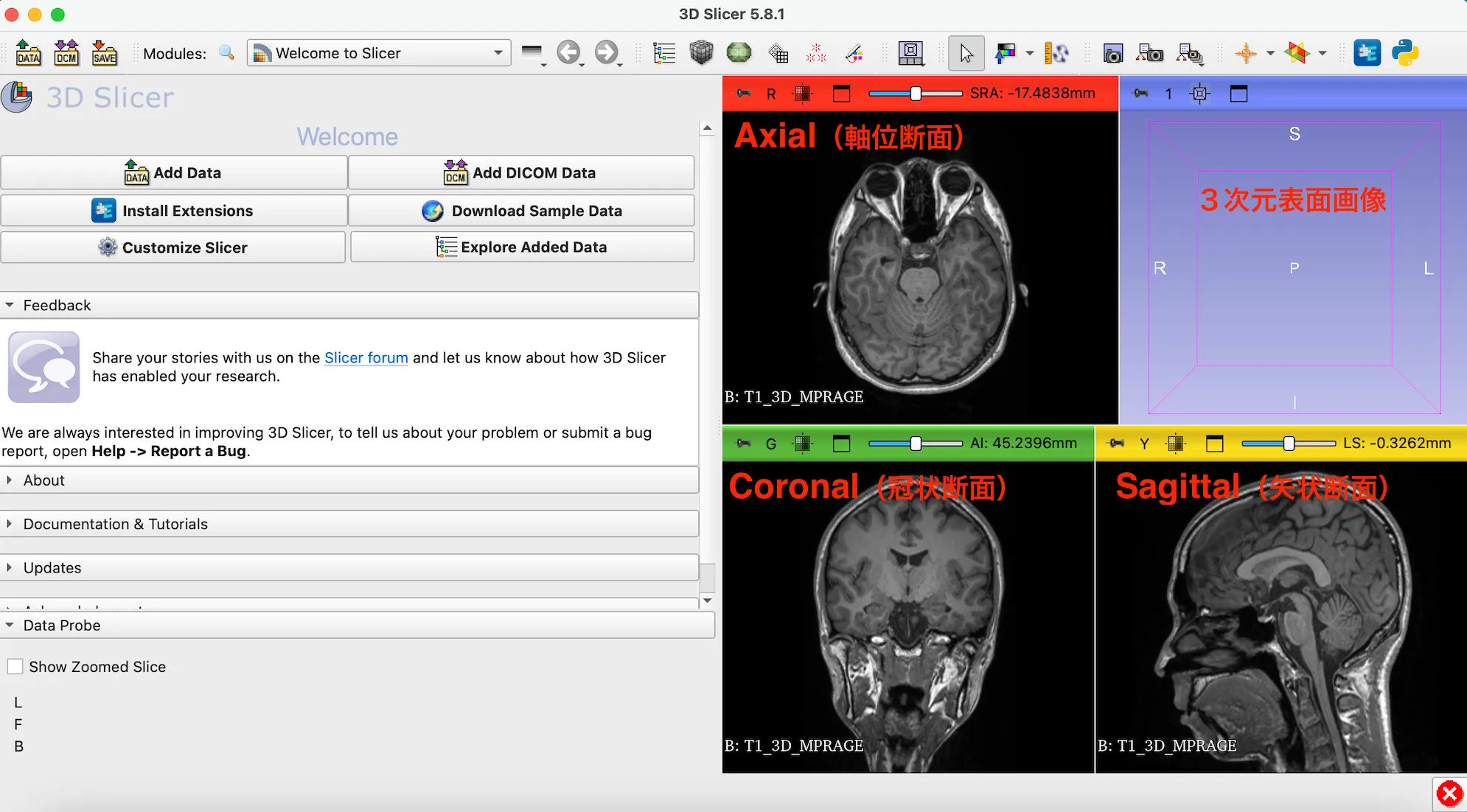 3D Slicer徹底解説！確認からセグメンテーションまで医療画像用の処理ツールを実際につかってみよう！ 本文画像10