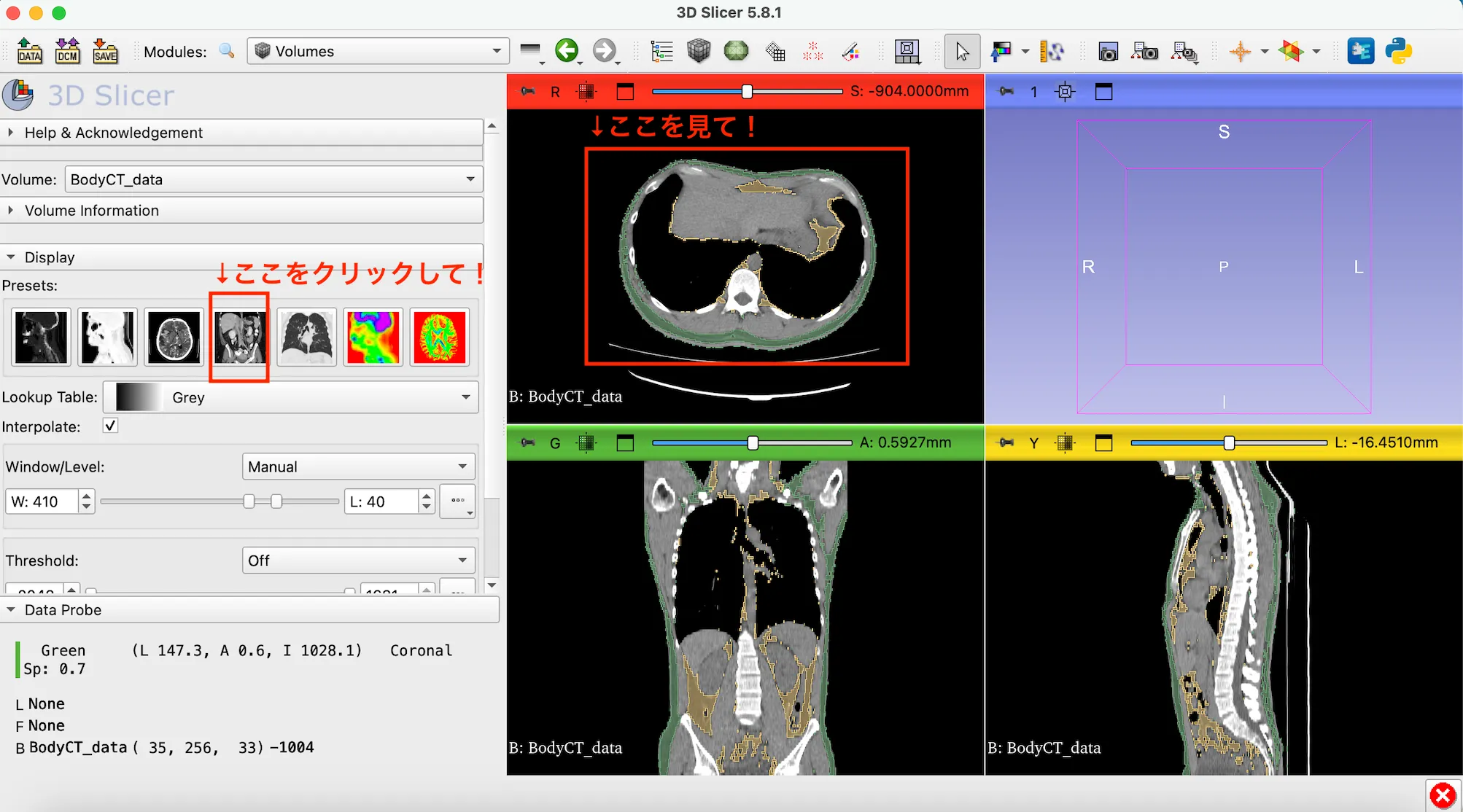 3D Slicer徹底解説！確認からセグメンテーションまで医療画像用の処理ツールを実際につかってみよう！ 本文画像36