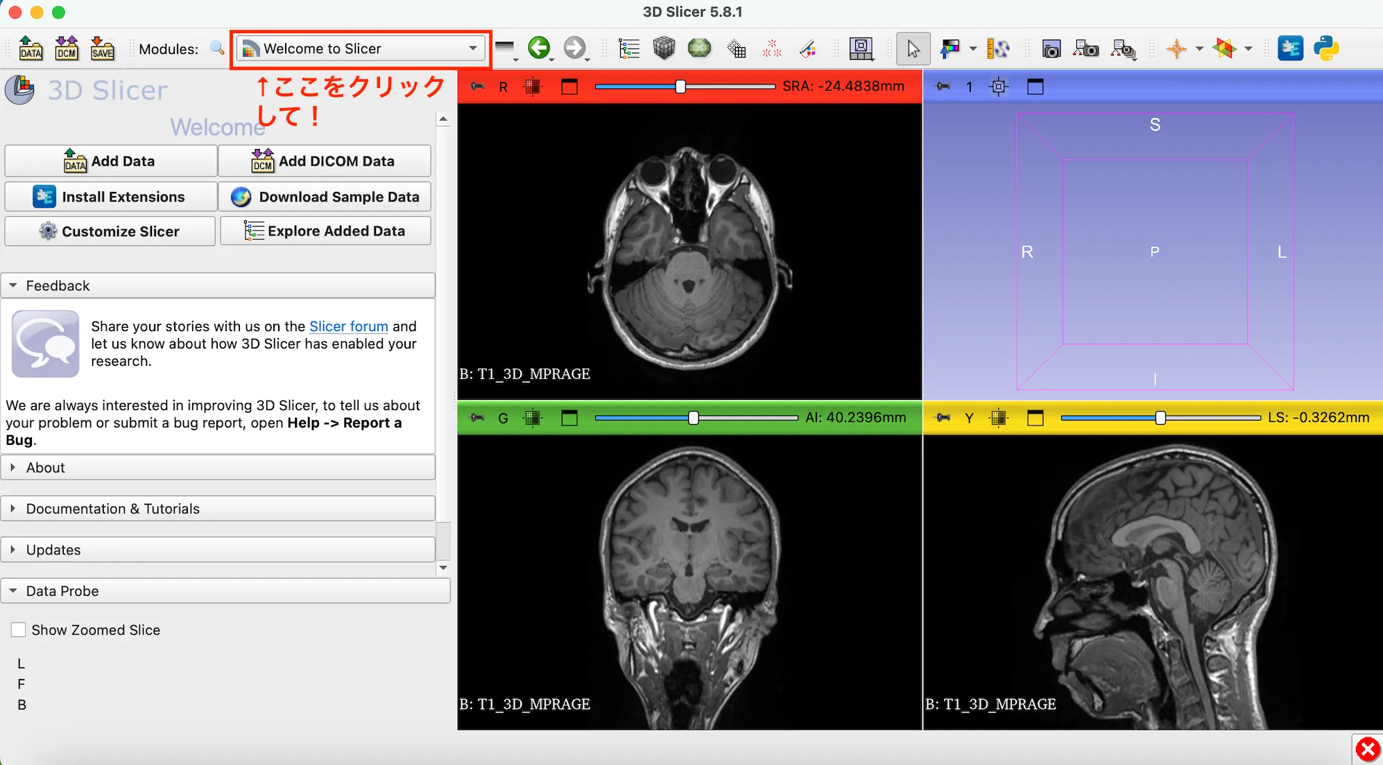 3D Slicer徹底解説！確認からセグメンテーションまで医療画像用の処理ツールを実際につかってみよう！ 本文画像12