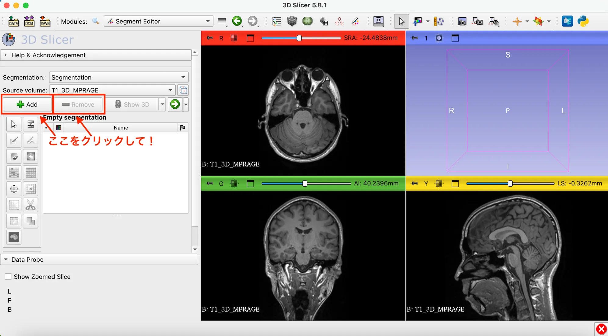 3D Slicer徹底解説！確認からセグメンテーションまで医療画像用の処理ツールを実際につかってみよう！ 本文画像14