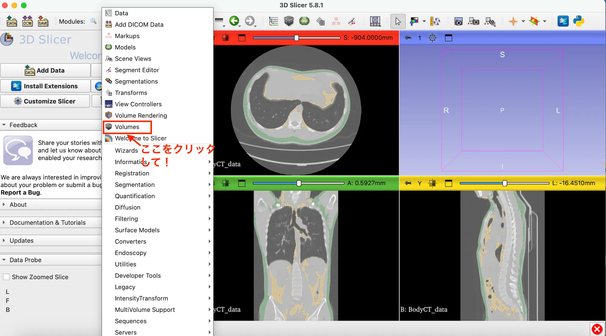 3D Slicer徹底解説！確認からセグメンテーションまで医療画像用の処理ツールを実際につかってみよう！ 本文画像35