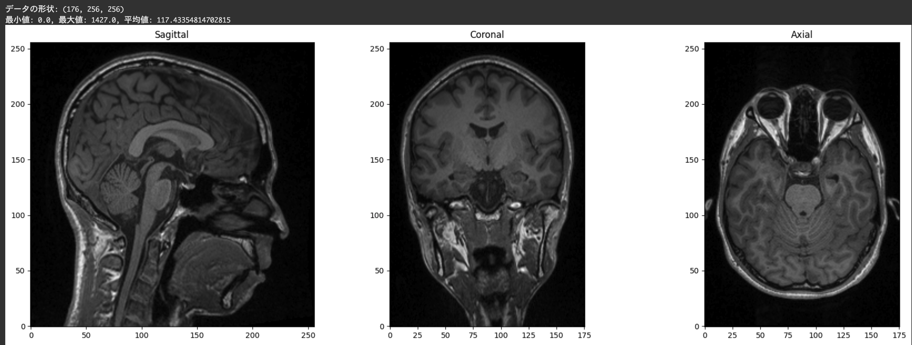 NiBabel徹底入門！Pythonで医療画像処理を実践しよう 本文画像