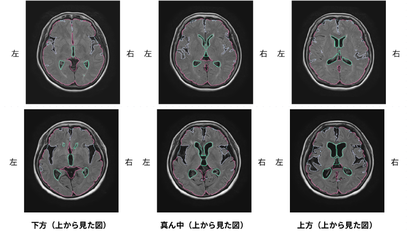 脳の萎縮は防げる？年齢に負けない脳の健康習慣とは