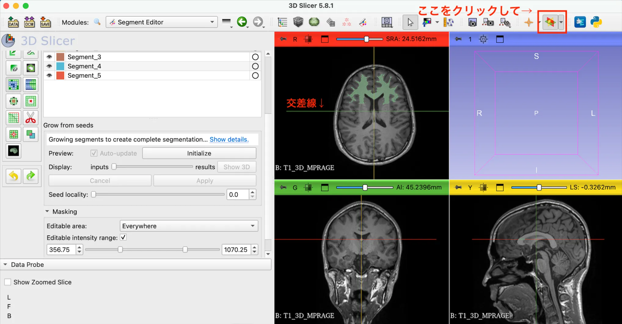 3D Slicer徹底解説！確認からセグメンテーションまで医療画像用の処理ツールを実際につかってみよう！ 本文画像26