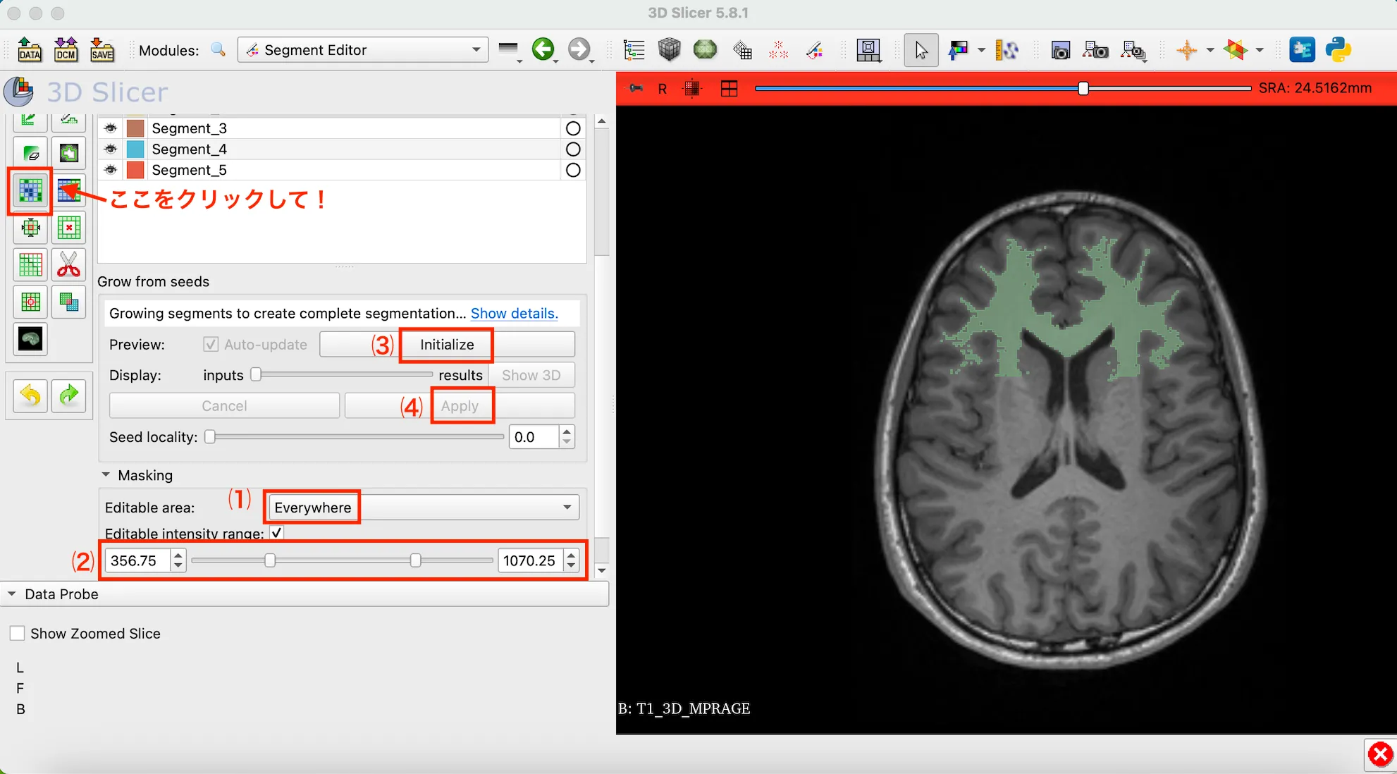 3D Slicer徹底解説！確認からセグメンテーションまで医療画像用の処理ツールを実際につかってみよう！ 本文画像25