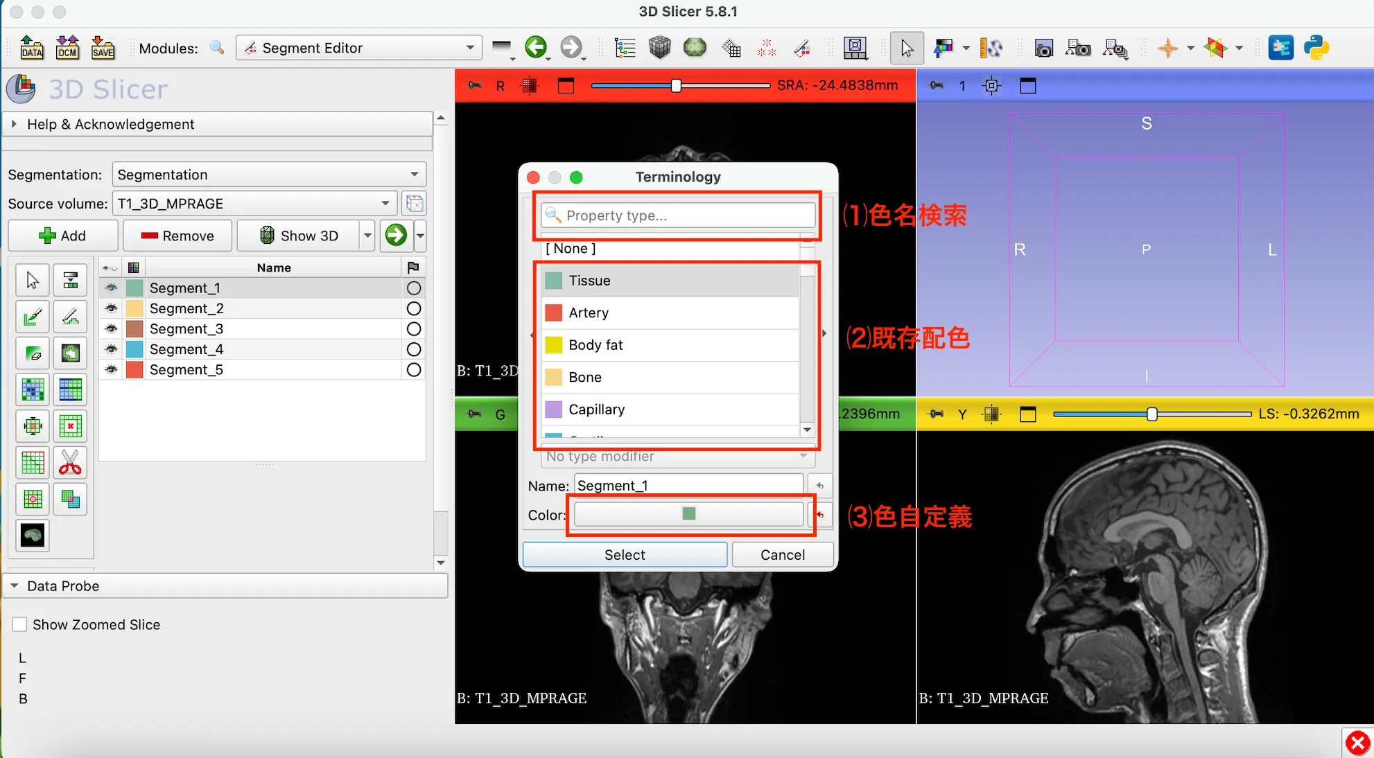 3D Slicer徹底解説！確認からセグメンテーションまで医療画像用の処理ツールを実際につかってみよう！ 本文画像16