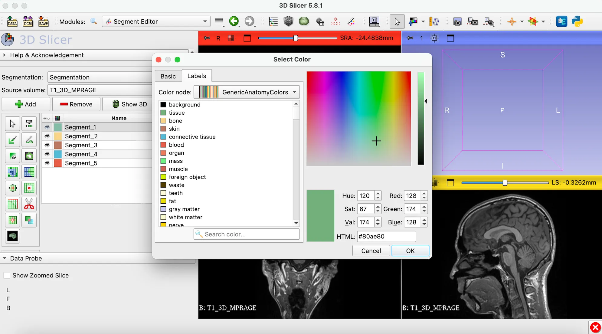 3D Slicer徹底解説！確認からセグメンテーションまで医療画像用の処理ツールを実際につかってみよう！ 本文画像17
