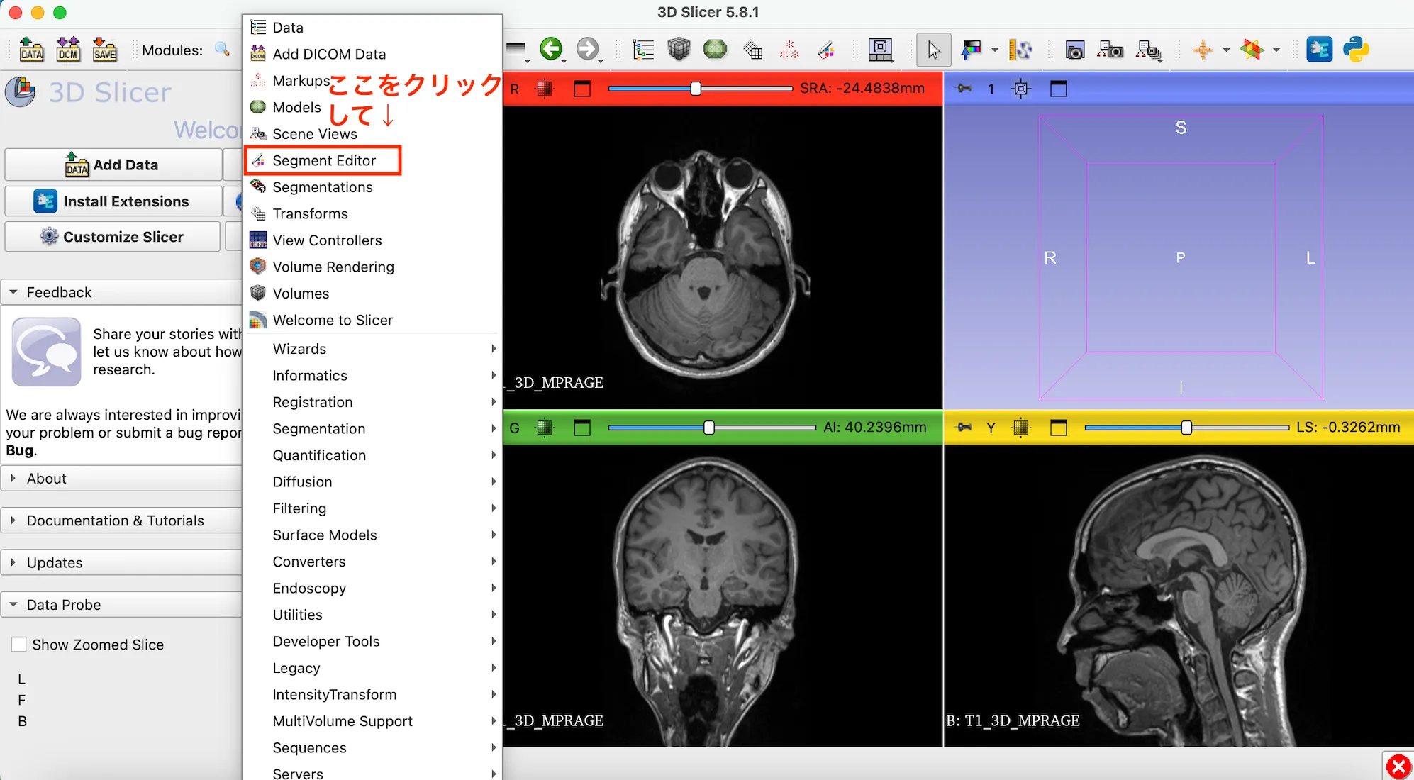 3D Slicer徹底解説！確認からセグメンテーションまで医療画像用の処理ツールを実際につかってみよう！ 本文画像13