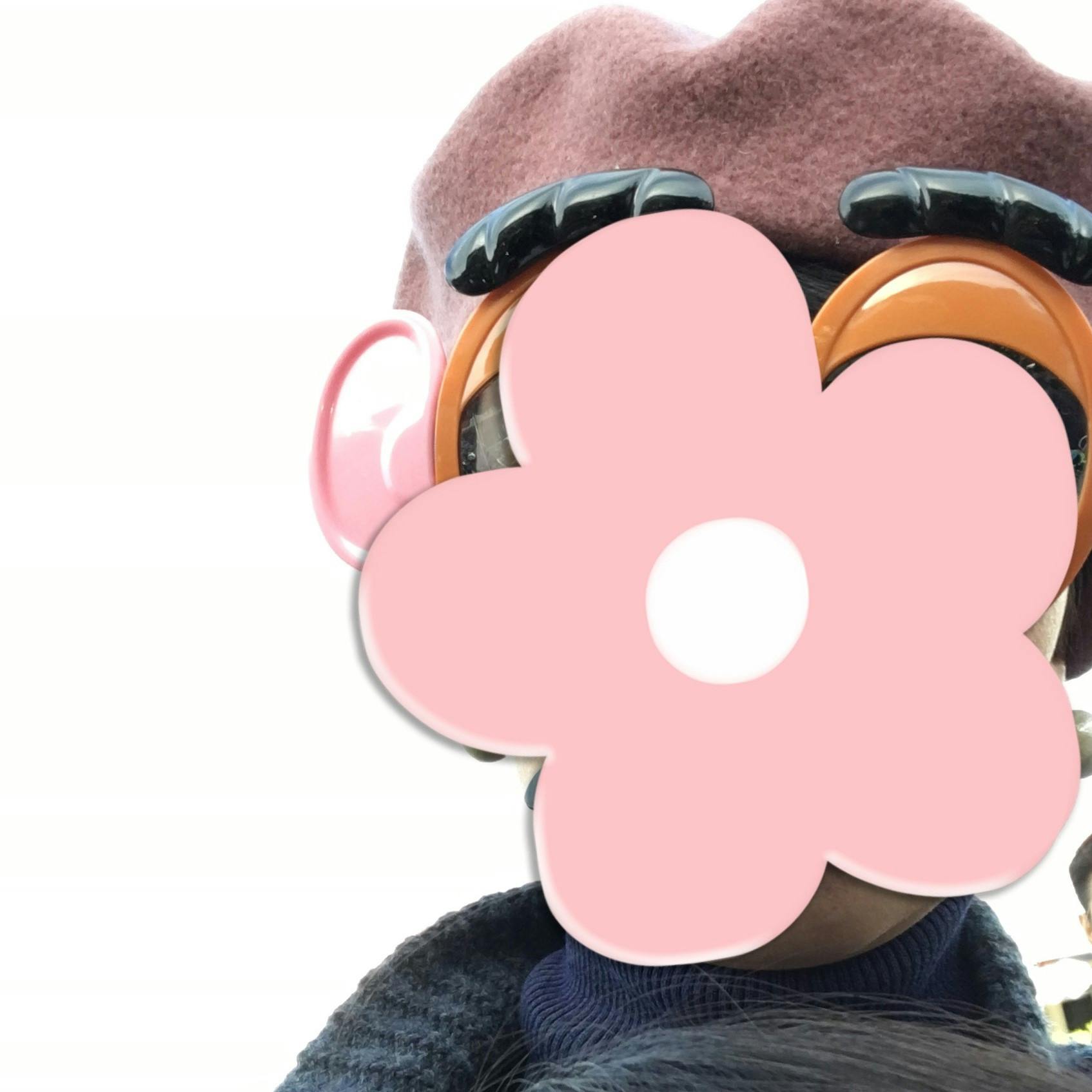 両頬に大きめの吹き出物 Lasela 両頬に大きめの吹き出物 Lasela