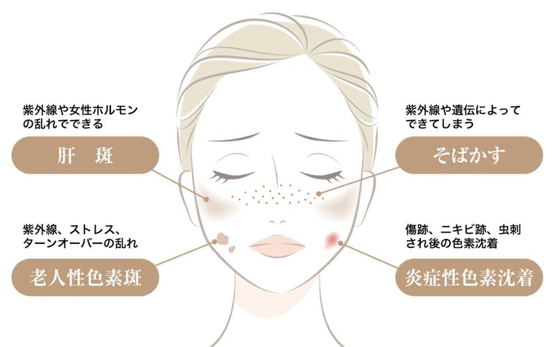 そばかすを消すことは本当にできるの 皮膚科での治療と自宅でのスキンケア方法を解説 Lasela
