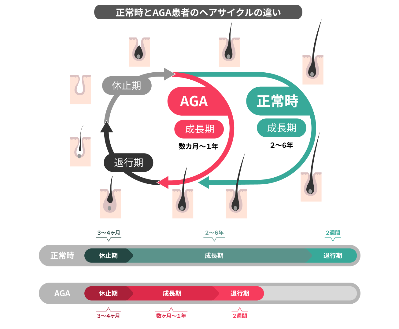 何故AGA治療は半年が目安なのか？髪の毛の生え変わり周期（ヘアサイクル）と紐づけて解説 | ヘアテクトBlog