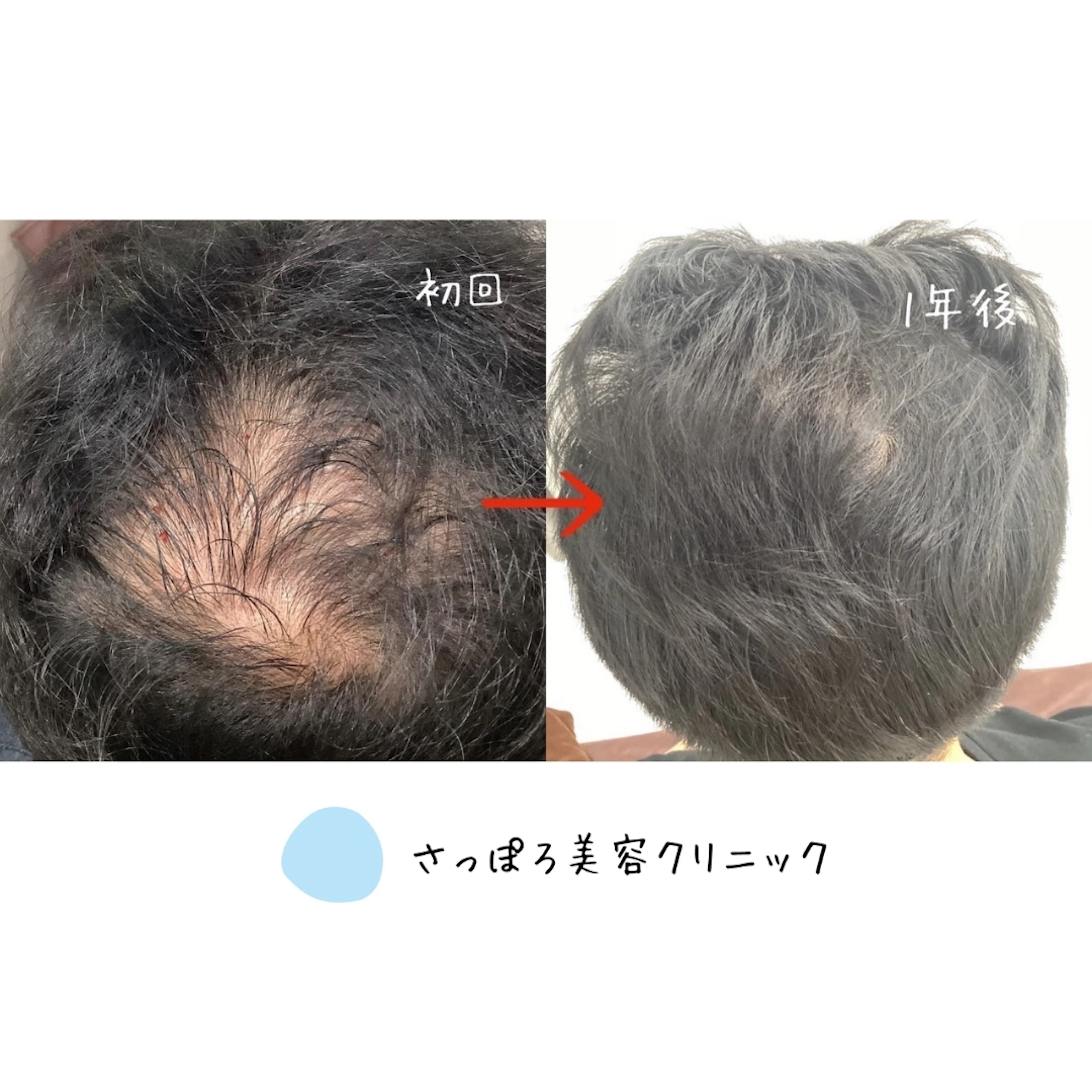 AGA治療