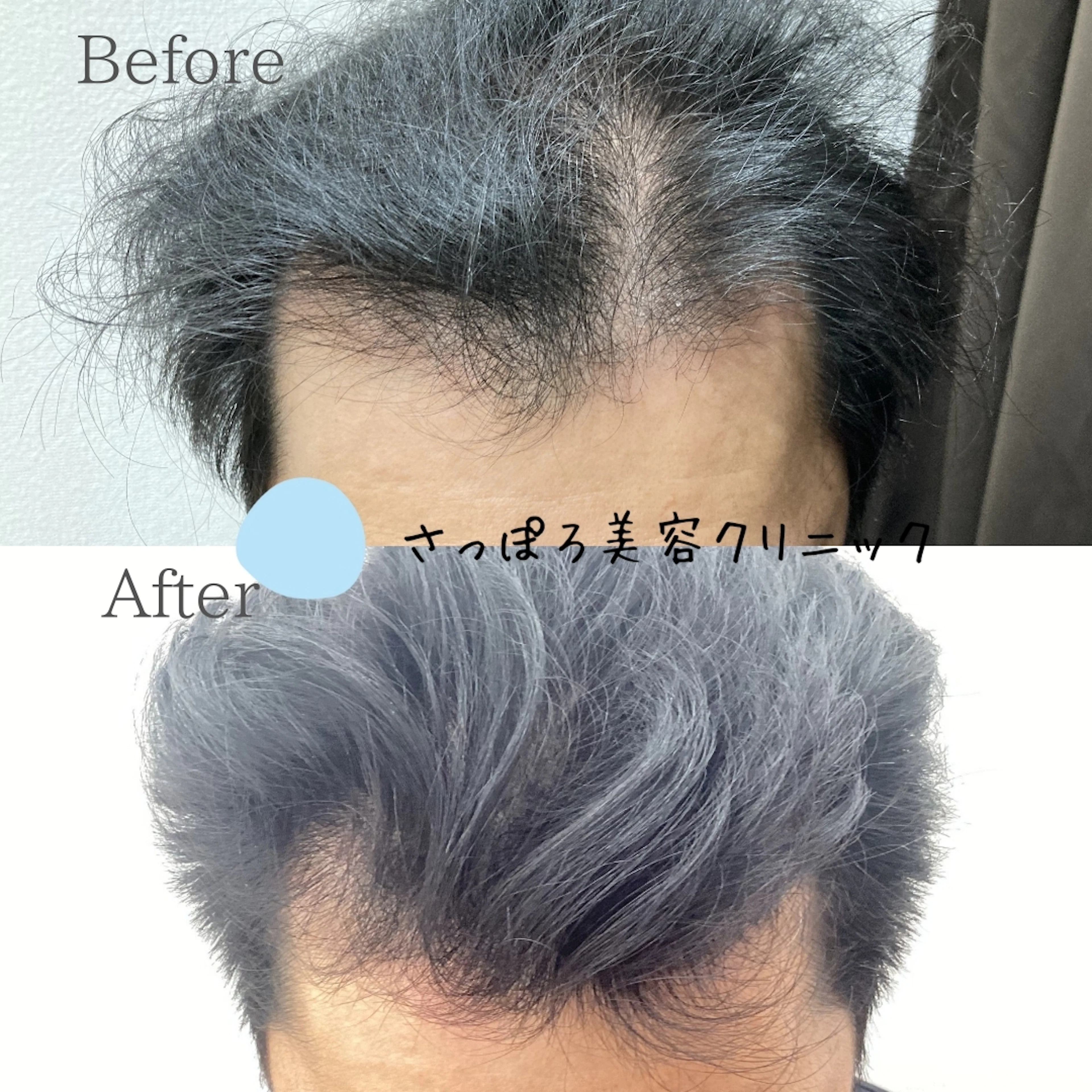 AGA治療
